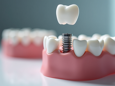 Sherwood Park Implants Guide: Dental Implants in Sherwood Park - What to Know