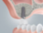 Implantatkrone nach Sinuslift