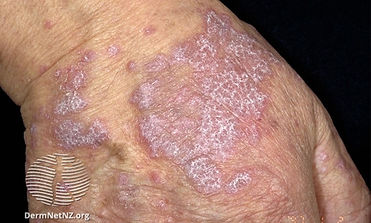 lichen planus hand.jpeg