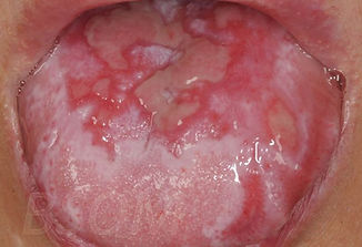 lichen planus tongue.jpeg