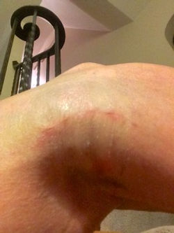Right knee damage