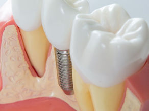 How to Care For Your Dental Implants for Longevity?