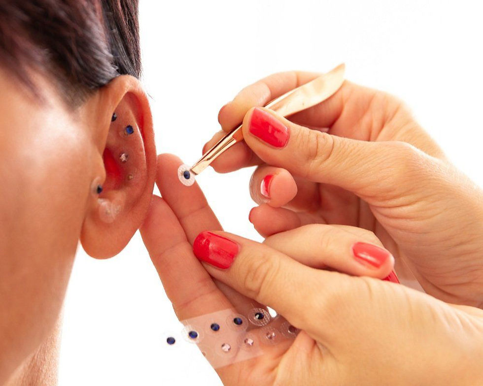 Tratamiendo natural de acupuntura 