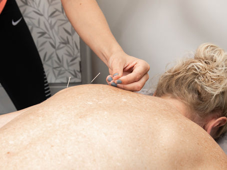 Why Dry Needling at TAP Could Be the Missing Link in Your Recovery & Performance