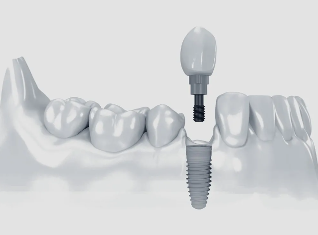 dental implant in marmaris