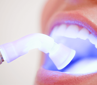 laser whitening