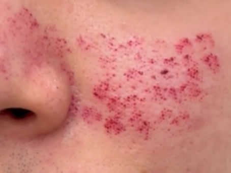 Laser Rejuvenation and Pinpoint Bleeding: A Clinical Guide for Practitioners