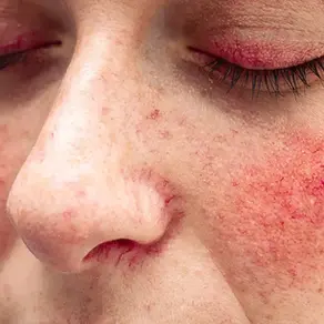 Reimagining Rosacea: A Non Invasive, Clinical Approach to Long Term Skin Management