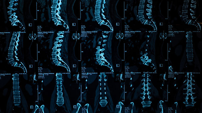 Astellas and Avexis Collaborate on Gene Therapy for Spinal Muscular Atrophy