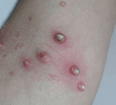 molluscum infected.png