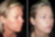 Acne Patient 8