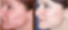 Acne Patient 1