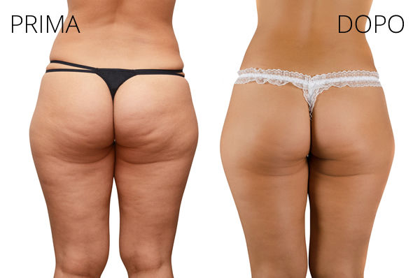 Thumbnail: PACCHETTO 5+1 MASSAGGIO COMPLETO: COPPETTA, MANUALE, PRESSO 1ora/seduta