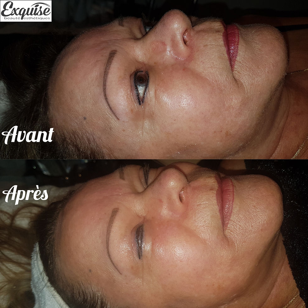 1er soin biocompatible