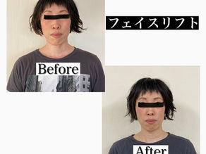 【キャンペーン】フェイスリフト 3,000円OFF