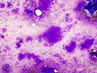 Cytopathology Case 3. Posterior neck mass from a middle-aged male patient.