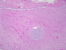 GU Case 5. Incidental kidney nodule found on partial nephrectomy surgery specimen
