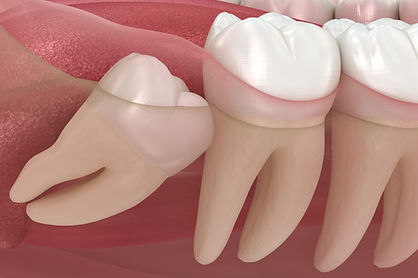 impacted-wisdom-teeth-scaled.jpg