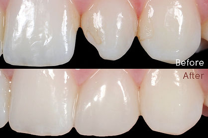 Composite-restoration.jpg