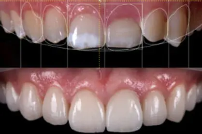 digital-smile-design-treatment.webp