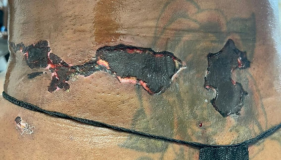 Lipo Burn: What It Is and How to Treat It
