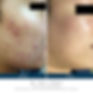Microneedling before after