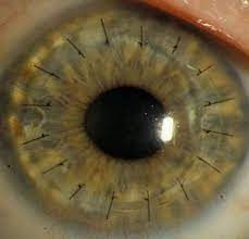 Cornea Fellowship Personal Statement, Ophthalmology, Saudi Ophthalmologist
