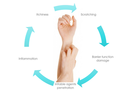 A Natural Approach to Eczema