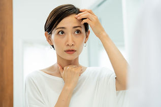 円形脱毛症治療