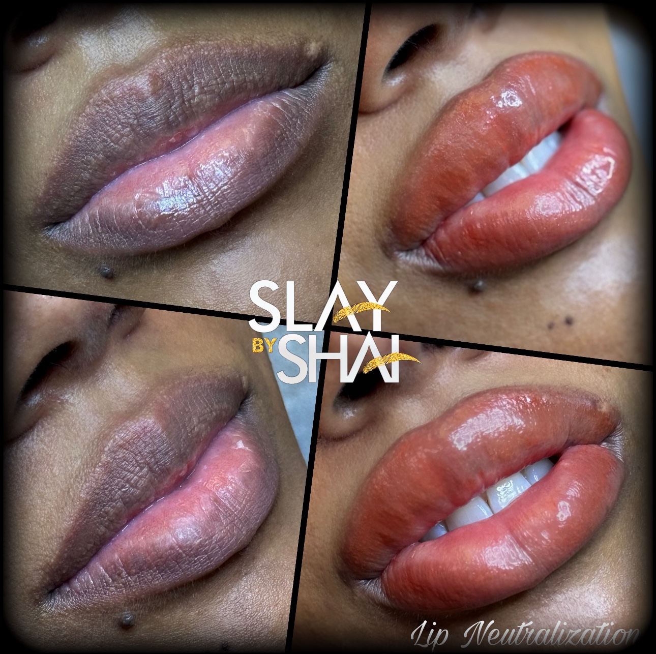Original client lip neutralization result — example 3