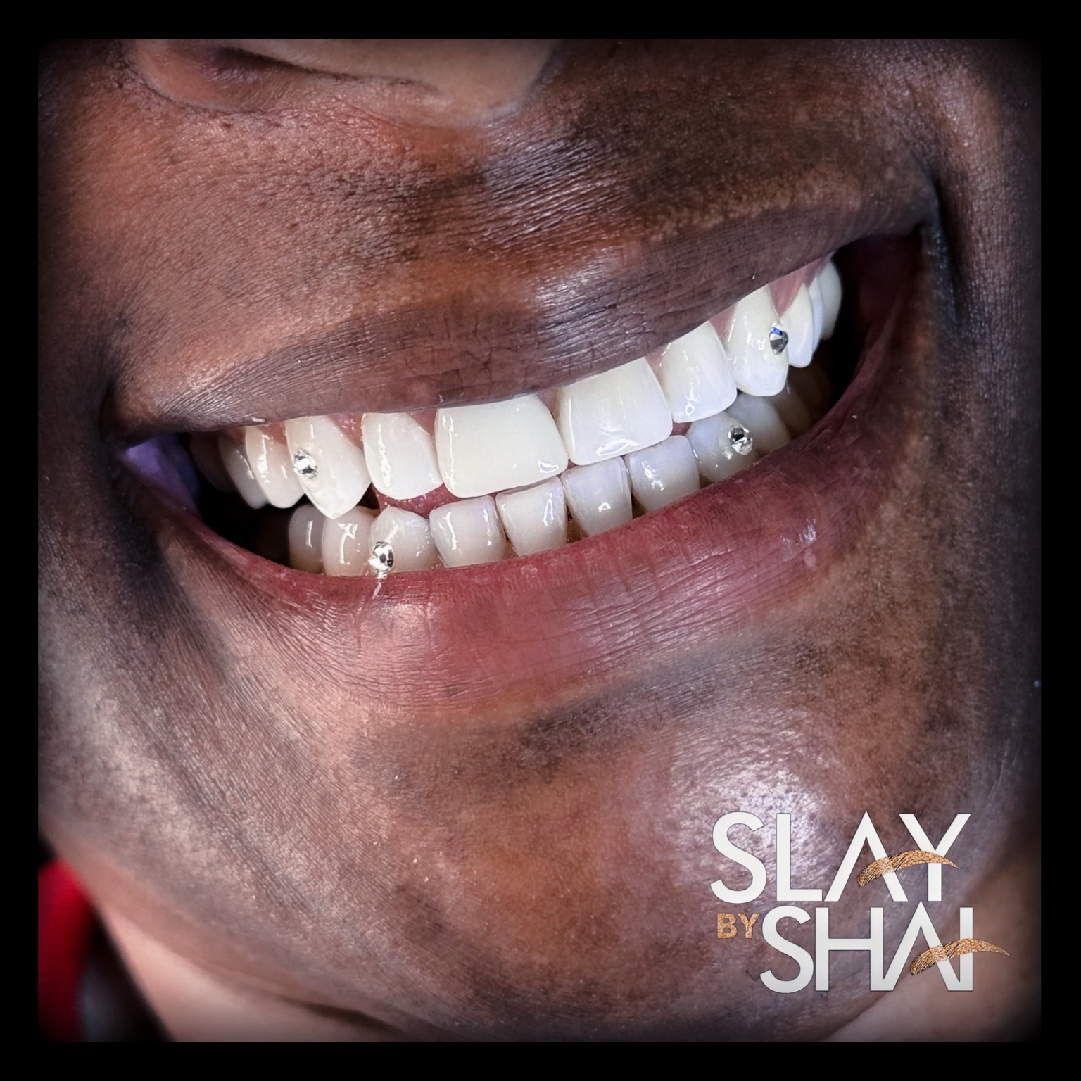 Original client tooth gem placement — example 3