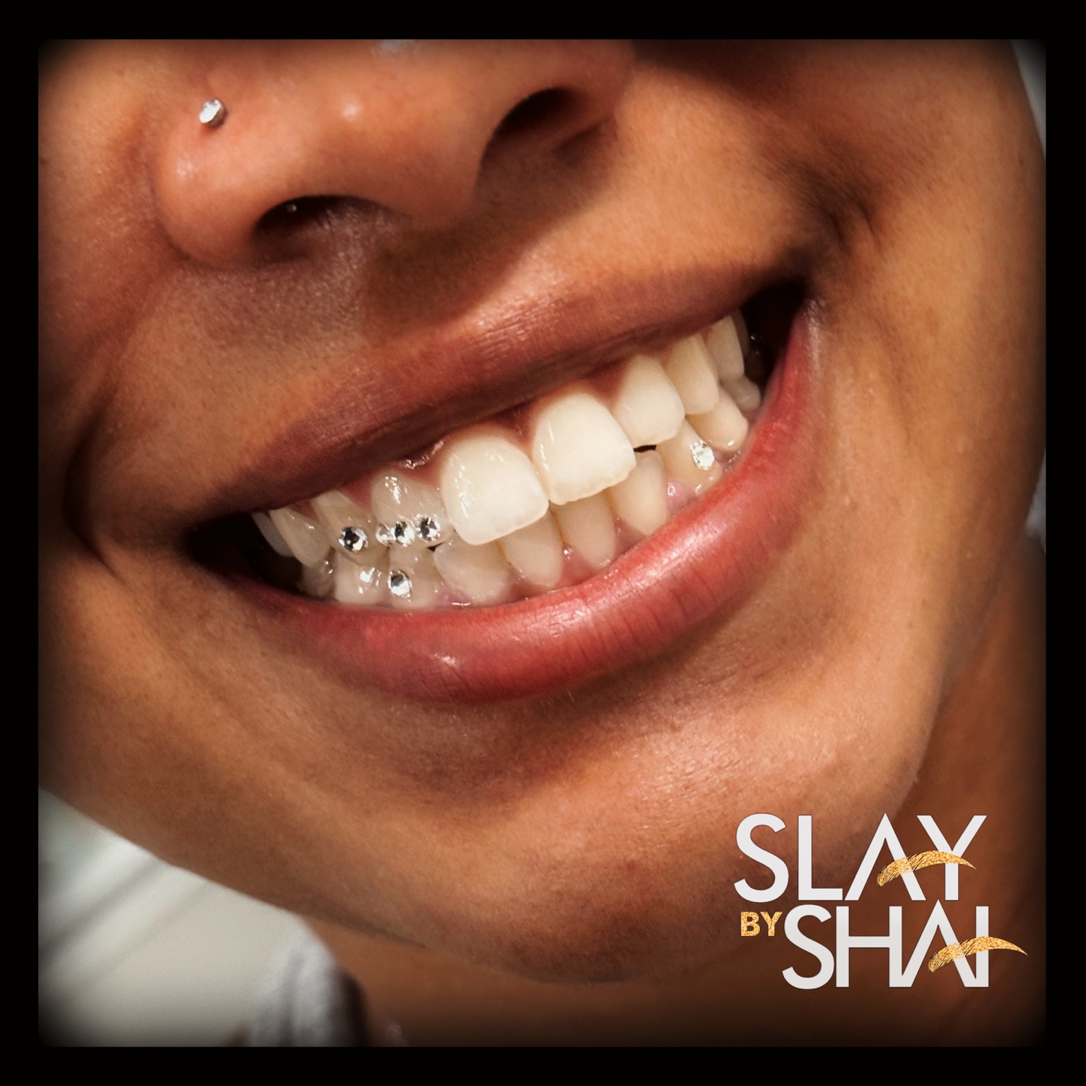 Original client tooth gem placement — example 2