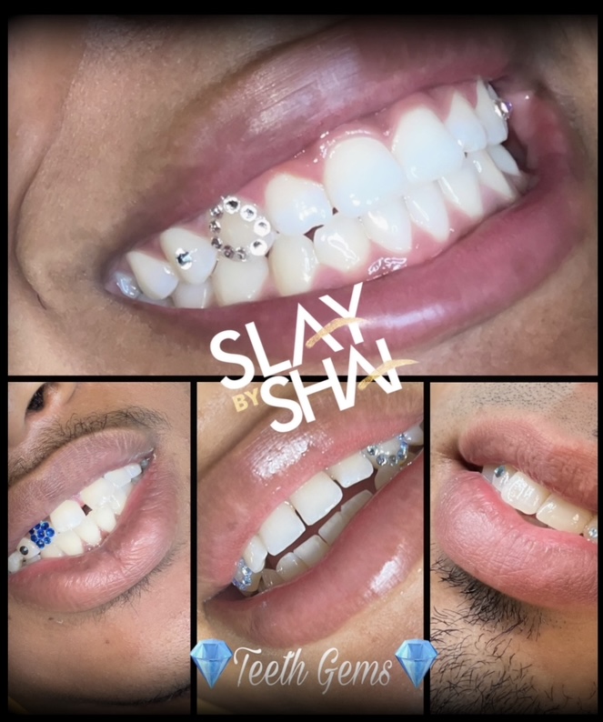 Original client tooth gem placement — example 4