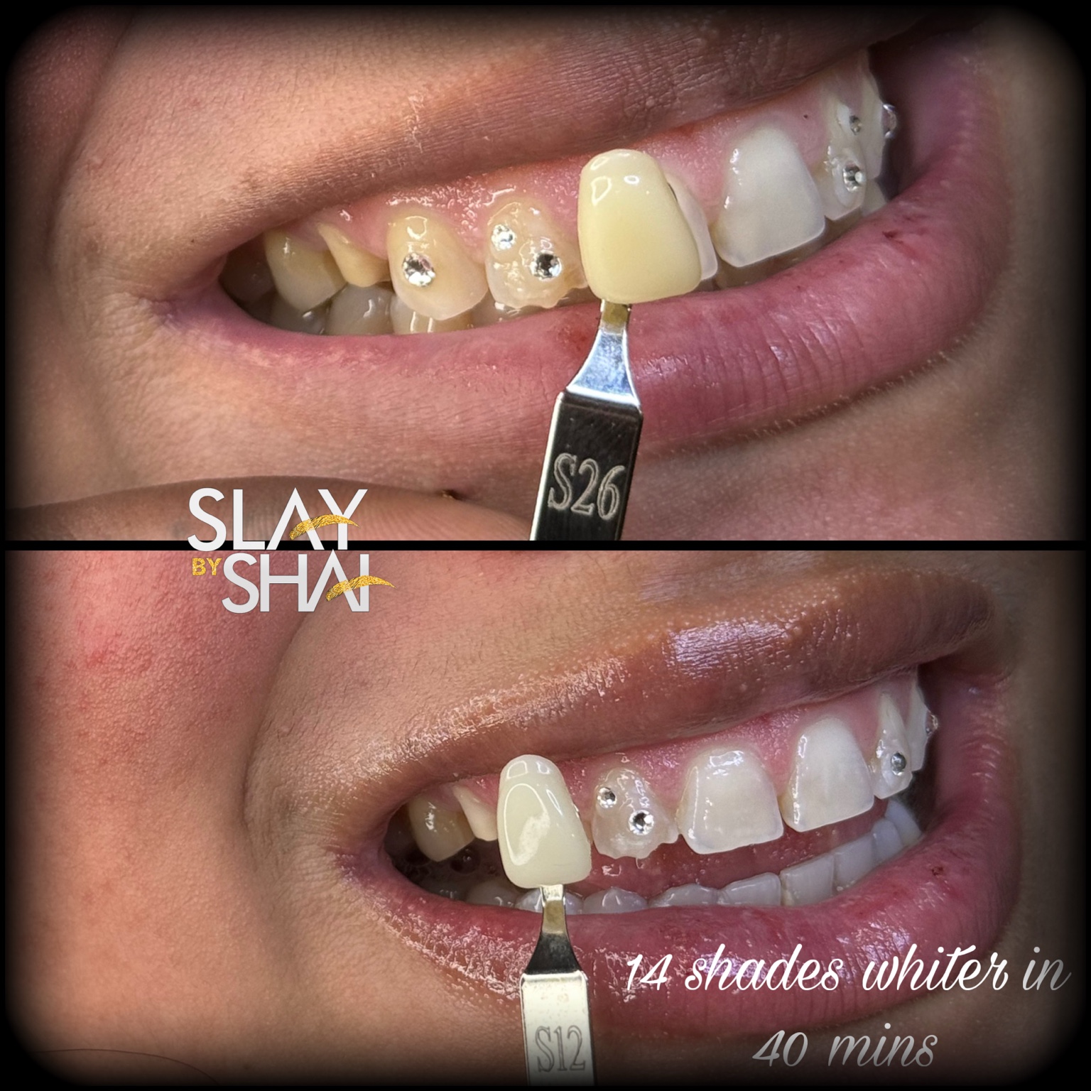 Original client teeth whitening before-and-after shade comparison — example 3