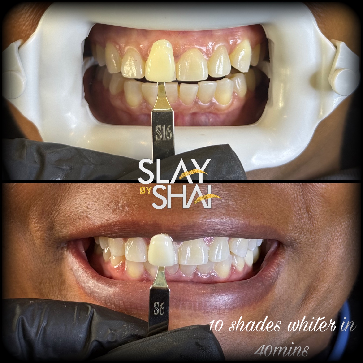 Original client teeth whitening before-and-after shade comparison — example 2