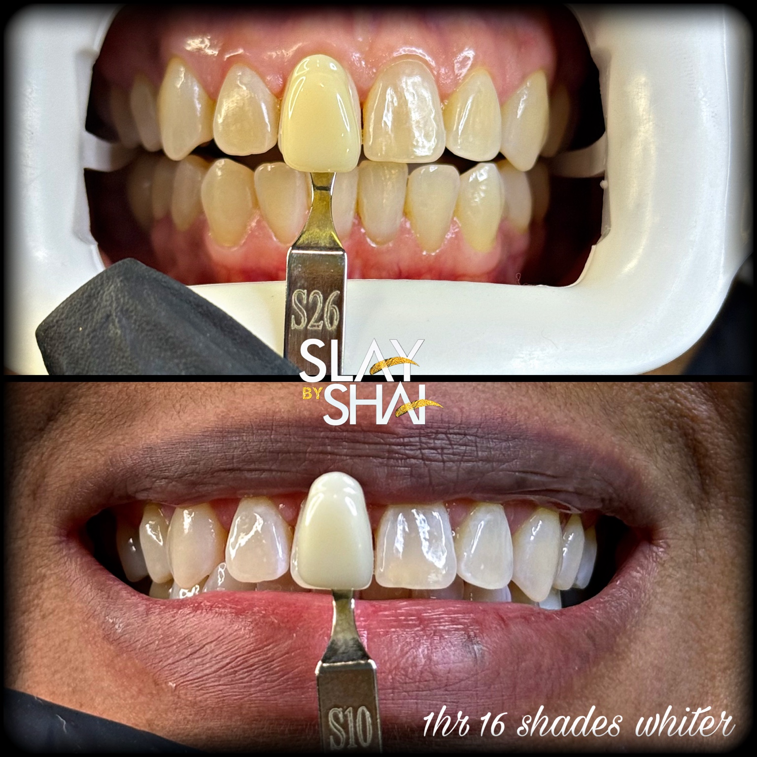 Original client teeth whitening before-and-after shade comparison — example 4