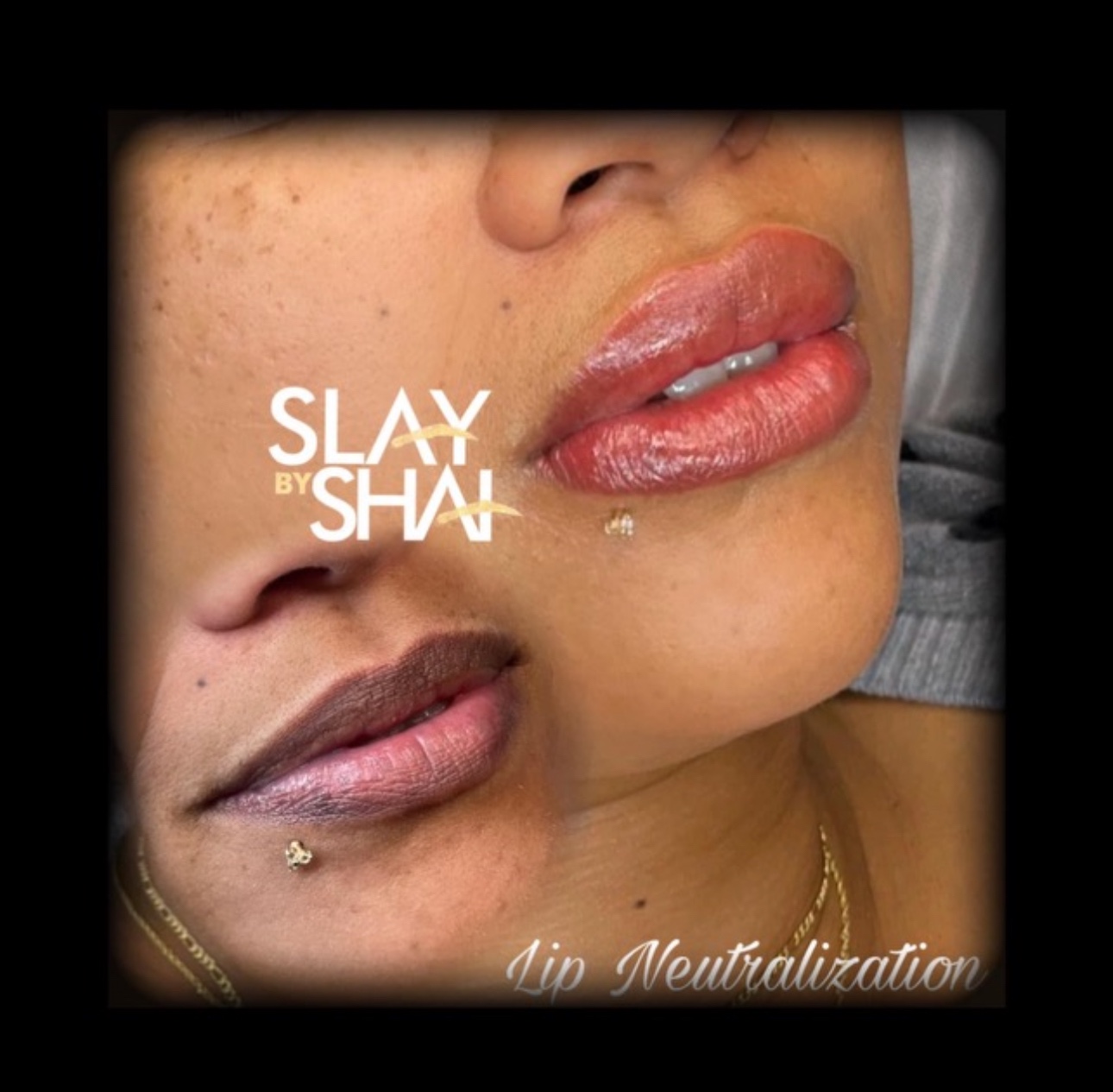 Original client lip neutralization result — example 5