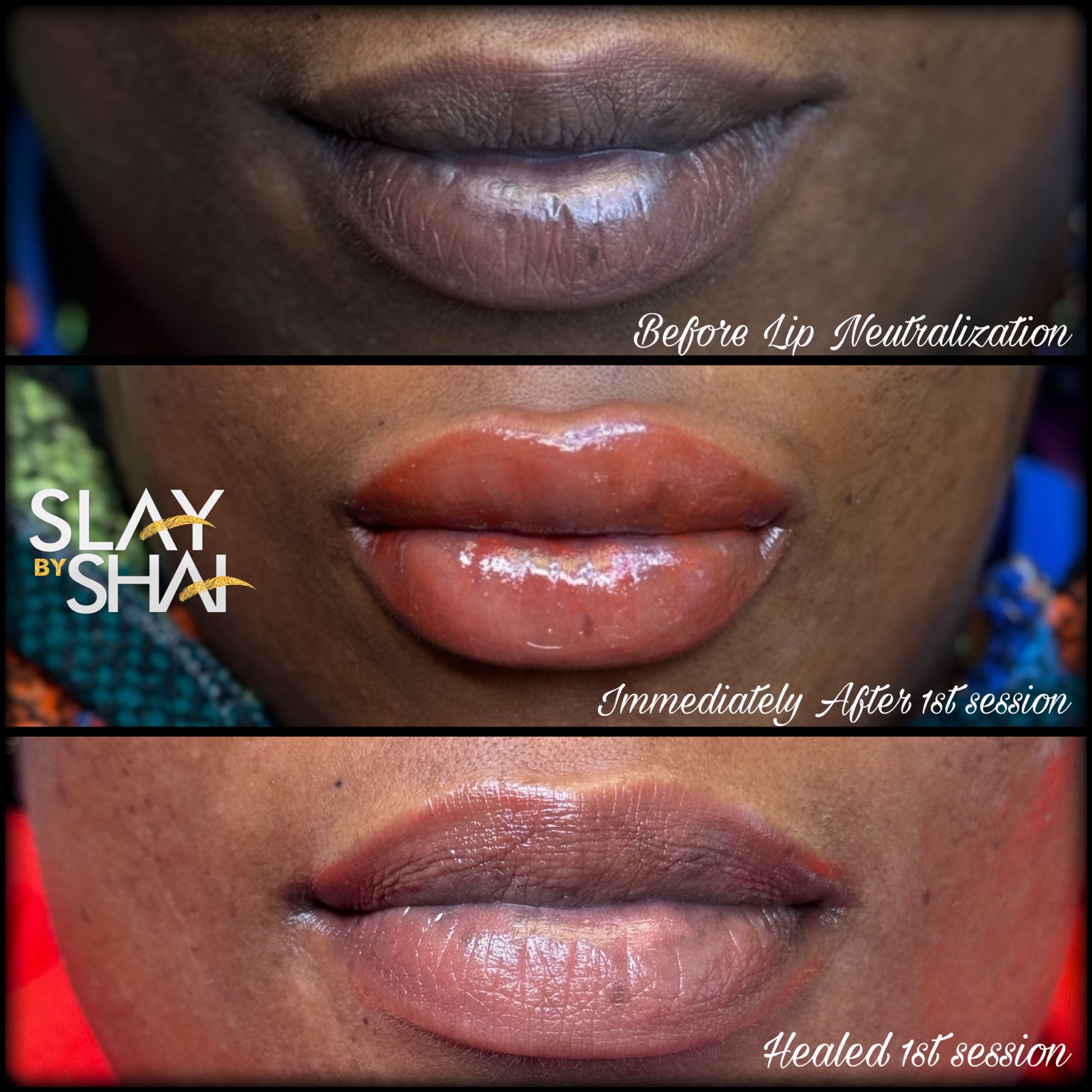 Original client lip neutralization result — example 4