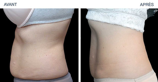 avant-apres-emsculpt-abdominaux-femme.jp