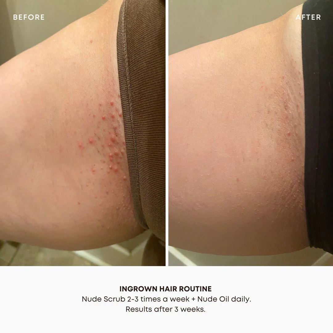 Nude Ingrown Hair Oil – Image 3