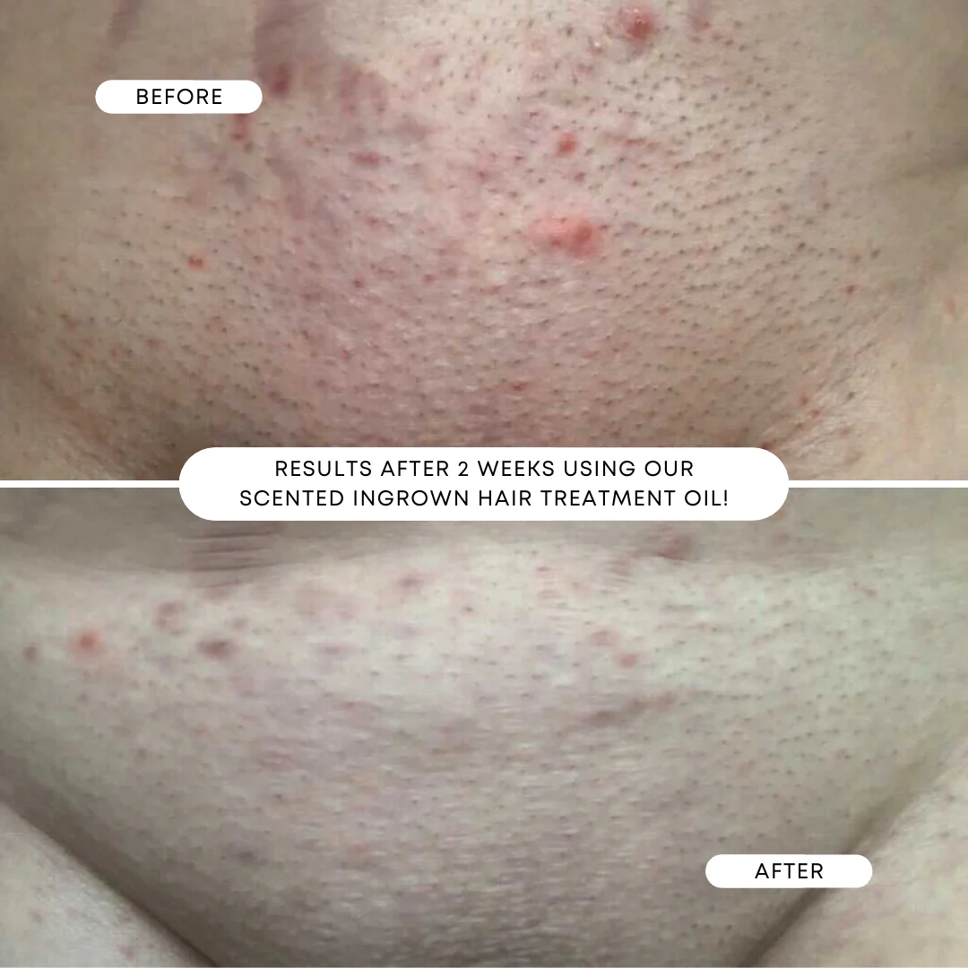 Sweet Escape Ingrown Hair Oil – Image 4