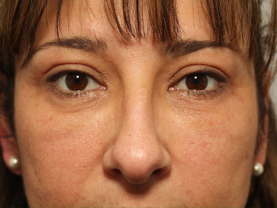 AFTER BILATERAL UPPER + LOWER EYELID BLEPHAROPLASTY WITH FAT GRAFTING TO THE LOWER EYELIDS