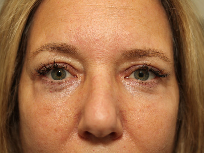 AFTER BILATERAL UPPER + LOWER EYELID BLEPHAROPLASTY, CO2 LASER TO THE LOWER EYELIDS
