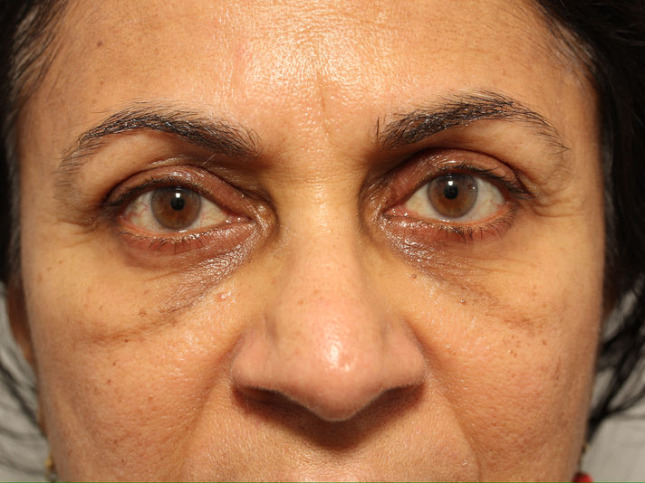 AFTER BILATERAL PTOSIS REPAIR