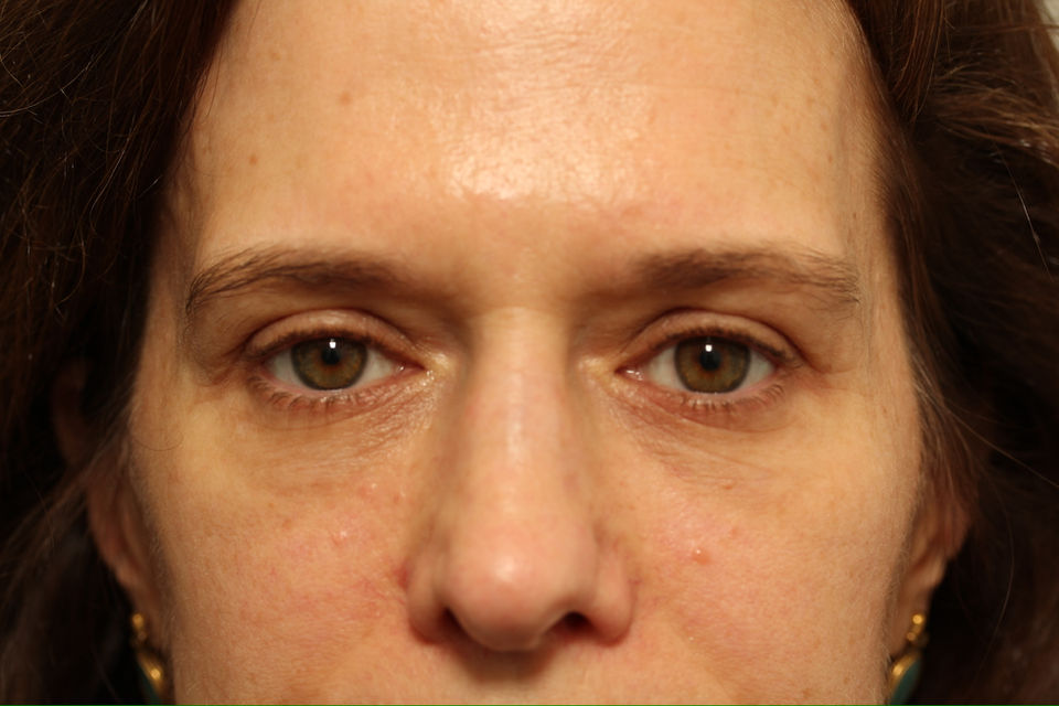 AFTER BILATERAL LOWER BLEPHAROPLASTY WITH FAT TRANSPOSITION + CO2 LASER TO THE LOWER EYELIDS