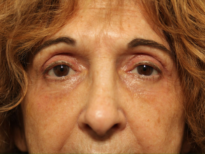 AFTER BILATERAL UPPER + LOWER EYELID BLEPHAROPLASTY WITH FAT TRANSPOSITION + CO2 LASER TO THE LOWER EYELIDS, ENDOSCOPIC BROW LIFT