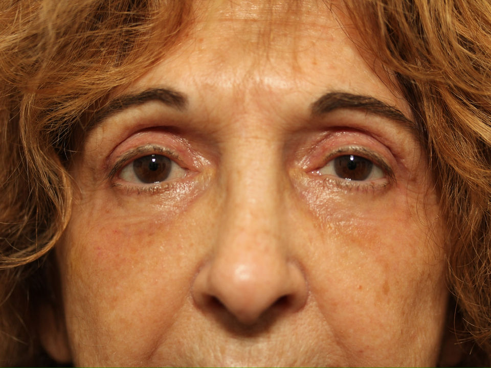 AFTER BILATERAL UPPER + LOWER BLEPHAROPLASTY WITH FAT GRAFTING + CO2 LASER TO THE LOWER EYELIDS, ENDOSCOPIC BROW LIFT