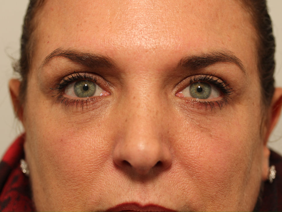 AFTER BILATERAL UPPER + LOWER EYELID BLEPHAROPLASTY, CO2 LASER TO LOWER EYELIDS