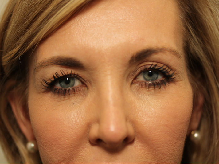 BEFORE BILATERAL UPPER EYELID BLEPHAROPLASTY