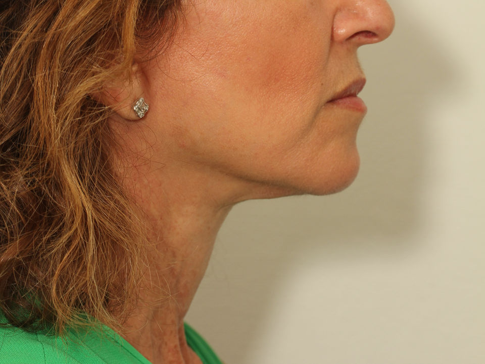 AFTER FACELIFT, BILATERAL LOWER EYELID BLEPHAROPLASTY